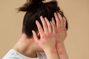 Apa itu herpes? Pengertian, jenis, ciri-ciri, serta cara mengatasinya dengan tepat