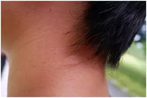 Cuma butuh wakut sehati, ini trik menghilangkan panu di leher hanya pakai 1 jenis buah saja