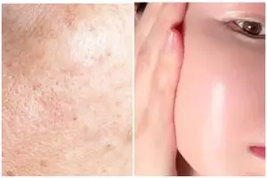  Cara bikin pori-pori jadi kecil ini hasilnya wajah auto mulus, andalkan serum dan 1 ampas dapur