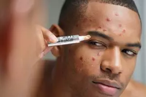 10 Concealer cowok harga di bawah Rp150 ribu, ampuh tutupi jerawat dan bekasnya dengan hasil natural