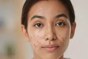 Cara menghilangkan bekas jerawat hitam di pipi dalam waktu singkat, ampuh dan efektif