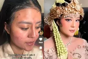 Kena cacar air H-3 nikah, wajah cewek penuh bekas luka ini disulap jadi mulus total saat resepsi