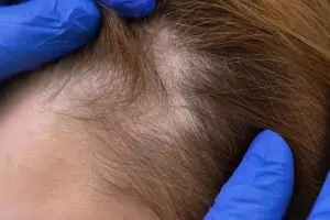 Rambut pitak bikin penampilan jelek? Ini cara menumbuhkannya tanpa hair tonic, pakai 2 bumbu dapur