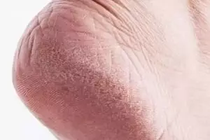 Punya tumit kasar yang sulit dihilangkan? Coba trik ini agar mulus kembali pakai 2 jenis buah