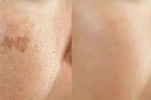 Wajah jadi cerah tanpa scrub, gunakan 2 jenis minuman ini untuk atasi flek hitam dan kusam