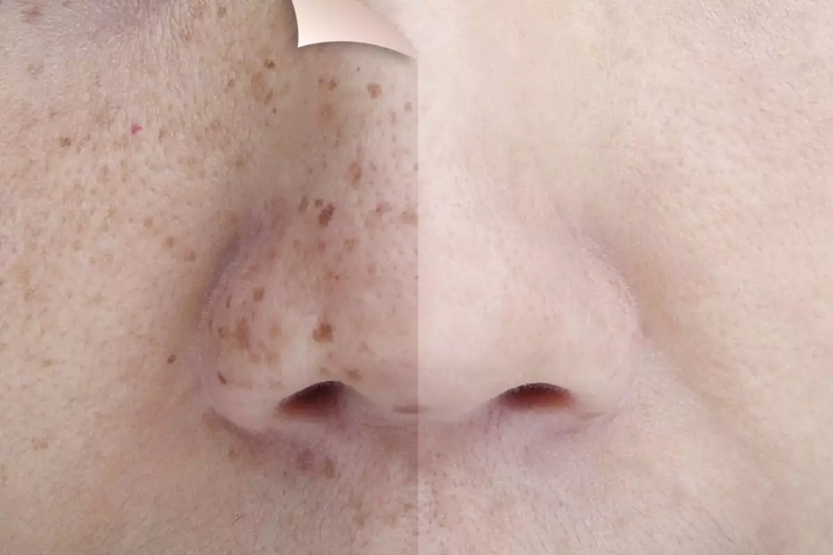 Tak perlu treatment laser, ini trik atasi flek hitam pakai kunyit dicampur 2 bahan alami, auto cerah