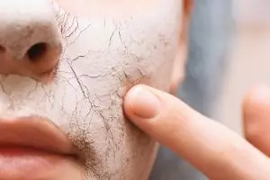 Nggak cuma dari skincare, ikuti 7 tips merawat kulit kering ini agar nggak bersisik dan mengelupas