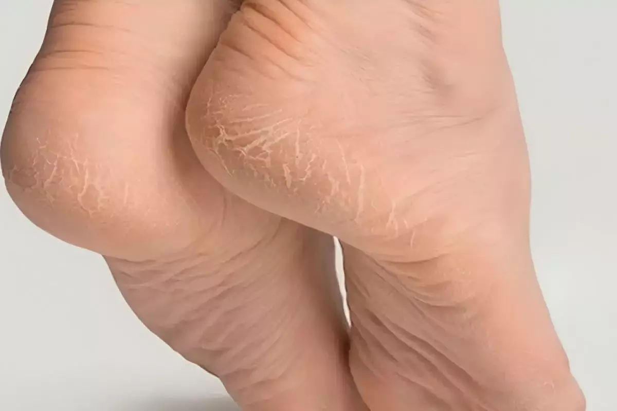 Tak perlu lakukan wax, ini cara menghaluskan tumit kaki yang retak dan menghitam pakai 1 jenis minyak