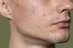 10 Skincare cowok penghilang bekas jerawat terbaru harga di bawah Rp 150 ribu