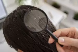 Trik menghilangkan kutu rambut simpel pakai 2 bahan alami, efektif dan praktis