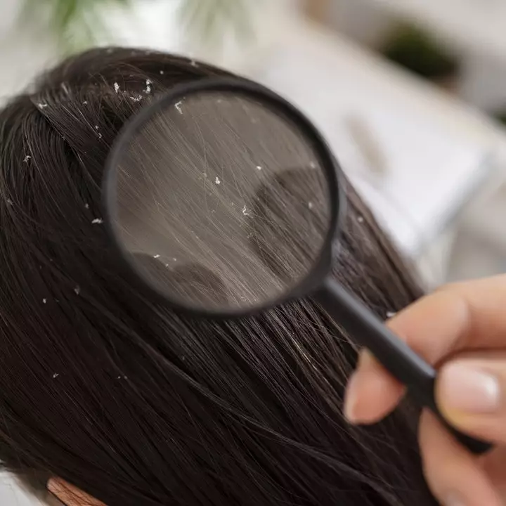 Trik menghilangkan kutu rambut simpel pakai 2 bahan alami, efektif dan praktis