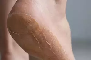 Lilin ditambah 2 jenis buah ini ternyata bisa bikin tumit kasar jadi bebas pecah-pecah, ini caranya