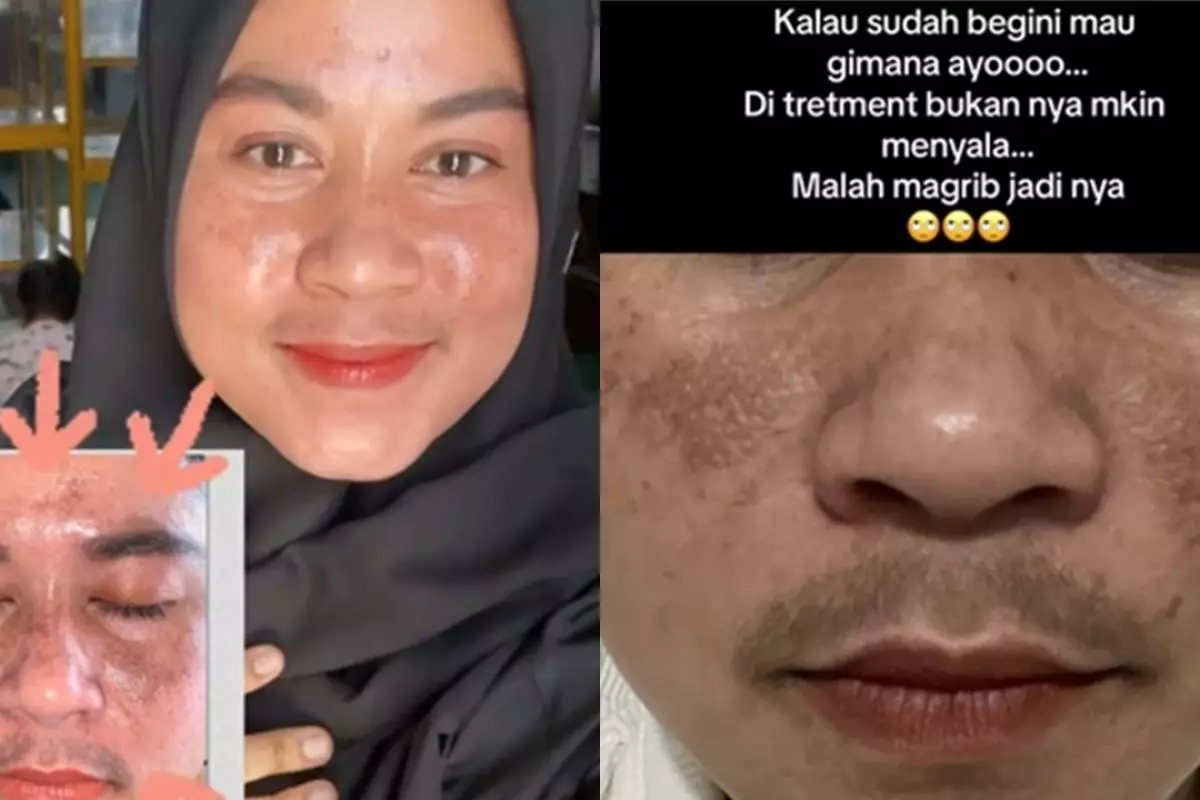 Merkuri bikin flek hitam, kisah perjuangan emak-emak cerahkan wajah saat hamil ini jadi sorotan