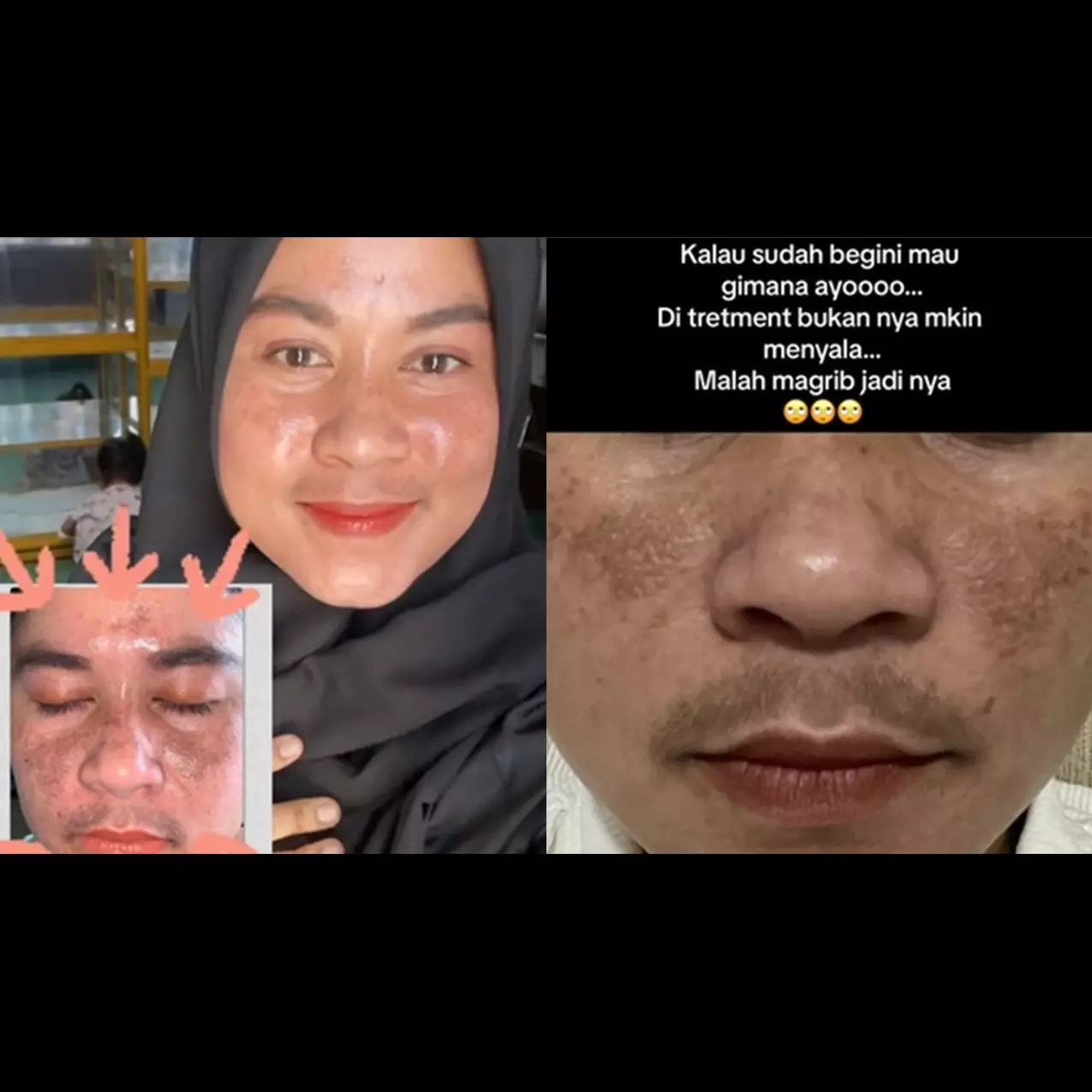 Merkuri bikin flek hitam, kisah perjuangan emak-emak cerahkan wajah saat hamil ini jadi sorotan