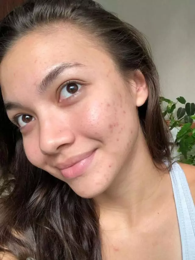 artis pamer wajah berjerawat © Instagram artis pamer wajah berjerawat © Instagram