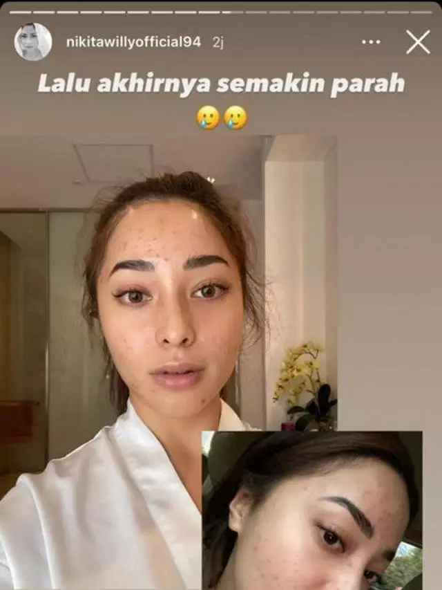 artis pamer wajah berjerawat © Instagram artis pamer wajah berjerawat © Instagram