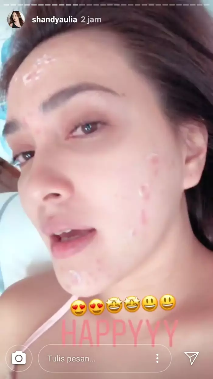 artis pamer wajah berjerawat © Instagram artis pamer wajah berjerawat © Instagram