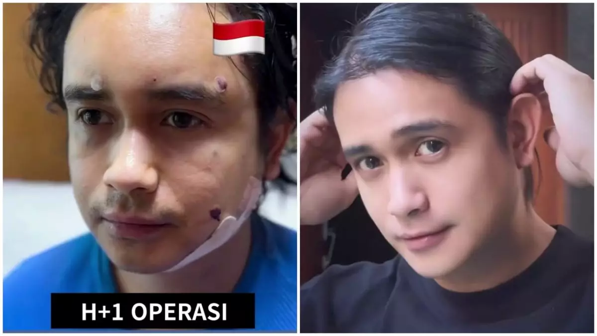 Sempat disebut jadi lebih tua karena oplas, begini 9 penampilan Ajun Perwira usai 8 bulan operasi dagu