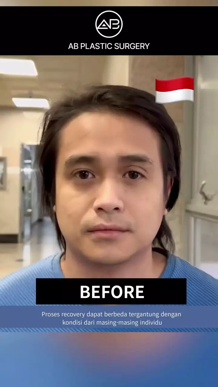 Penampilan Ajun Perwira usai operasi plastik © 2025 brilio.net