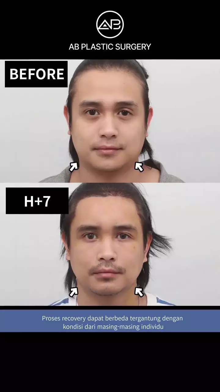 Penampilan Ajun Perwira usai operasi plastik © 2025 brilio.net