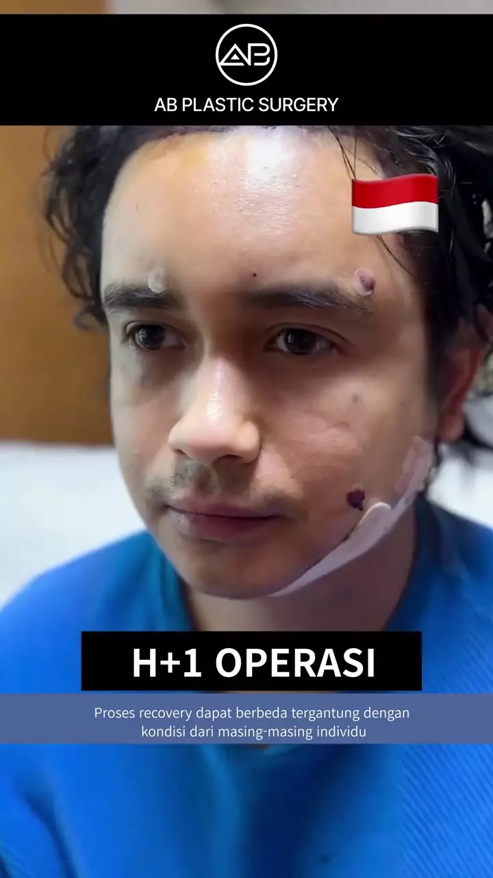 Penampilan Ajun Perwira usai operasi plastik © 2025 brilio.net
