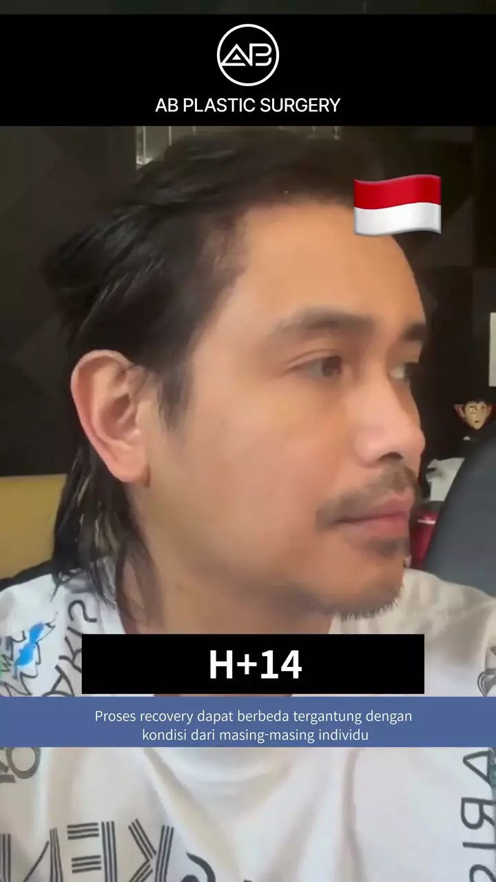 Penampilan Ajun Perwira usai operasi plastik © 2025 brilio.net