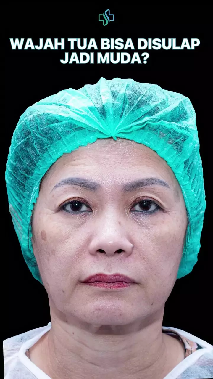 Ci Mehong facelift di usia 54 tahun © 2025 brilio.net Ci Mehong facelift di usia 54 tahun © 2025 brilio.net