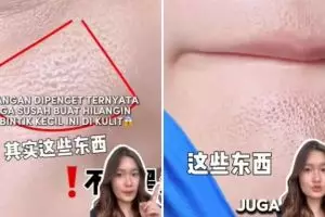 Stop dipencet! Ini cara ampuh hilangkan bintik kecil mirip komedo biar kulit kembali halus