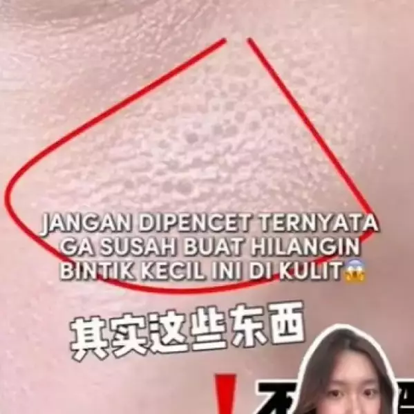 Stop dipencet! Ini cara ampuh hilangkan bintik kecil mirip komedo biar kulit kembali halus