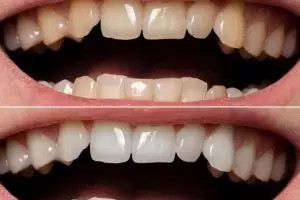 Trik memutihkan gigi kuning membandel cuma pakai 3 jenis buah, tanpa pakai garam