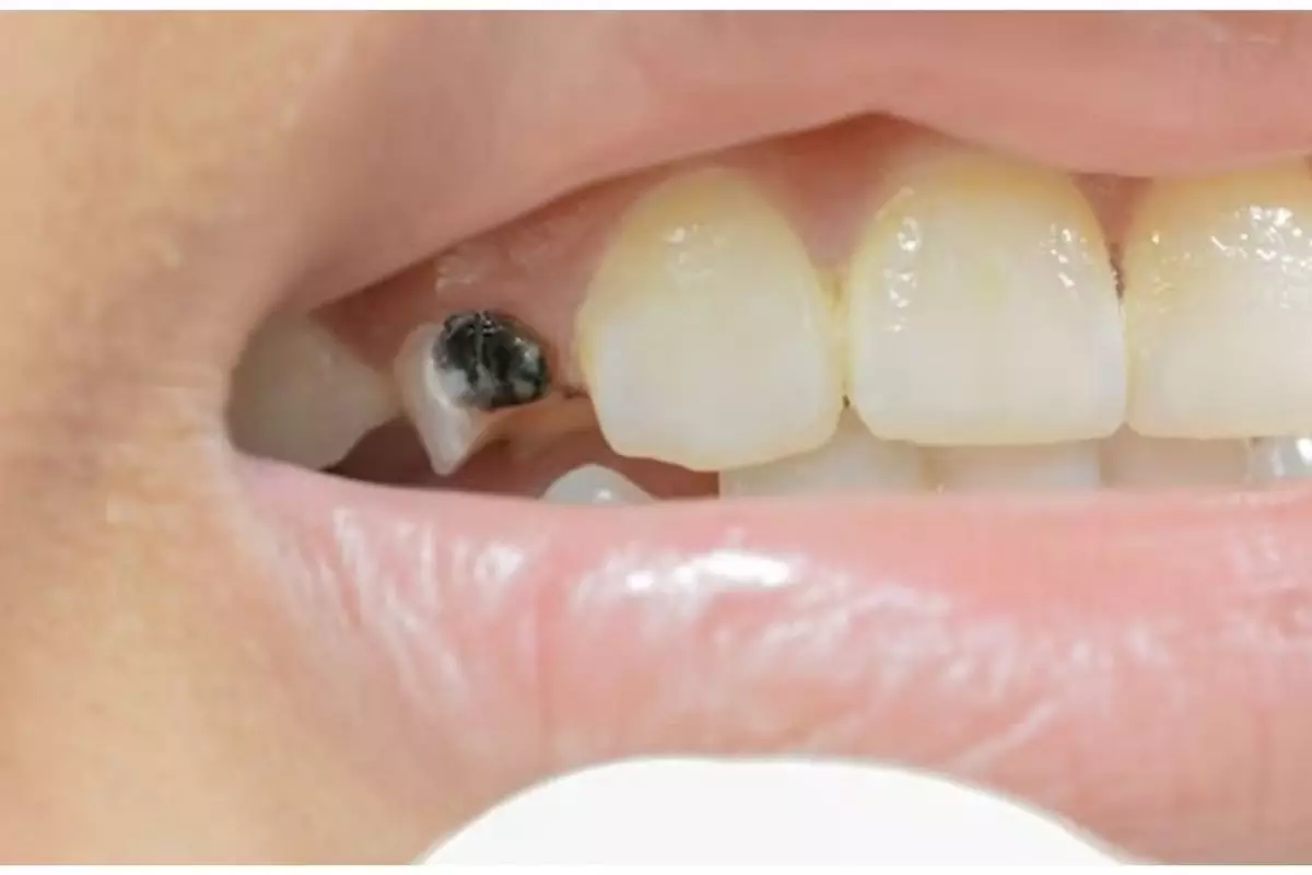 Gigi hitam kembali putih menggunakan 1 jenis biji-bijian, triknya tak perlu pakai baking soda