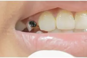 Gigi hitam kembali putih menggunakan 1 jenis biji-bijian, triknya tak perlu pakai baking soda