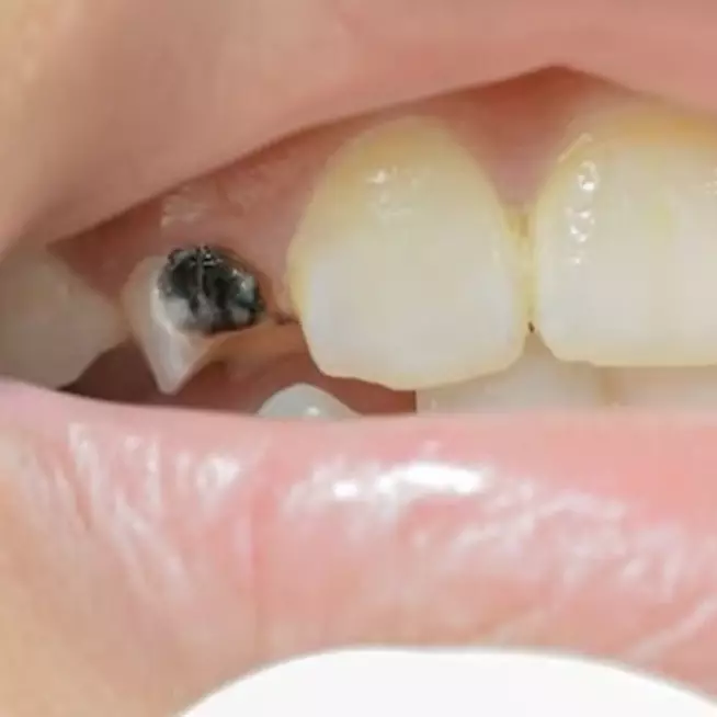 Gigi hitam kembali putih menggunakan 1 jenis biji-bijian, triknya tak perlu pakai baking soda