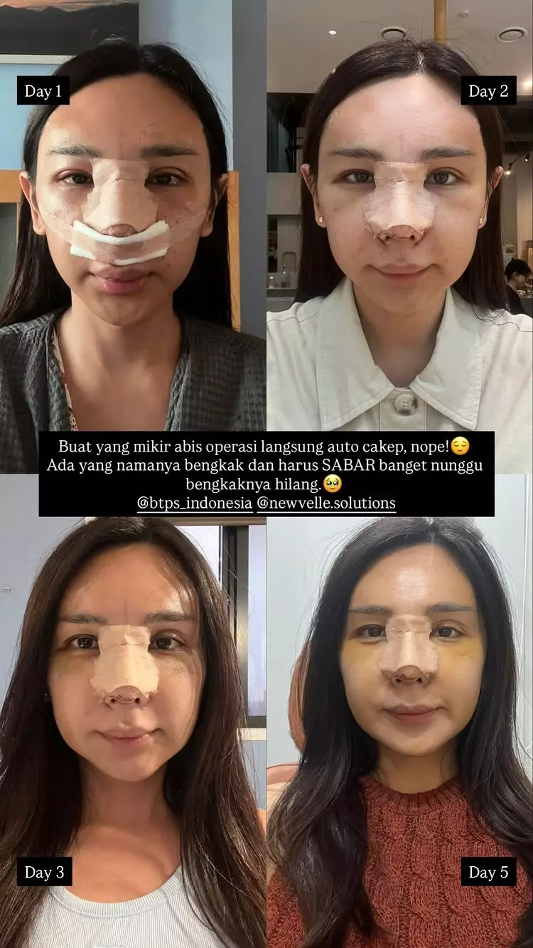 Dena Rachman jalani operasi plastik © 2025 Instagram