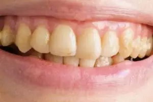 Trik memutihkan gigi kuning dengan 1 jenis ranting pohon, tanpa garam dan baking soda