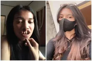 Ingat gadis bibir sumbing yang dioperasi gratis oleh Dokter Tompi? 9 potret terbarunya manglingi abis