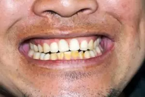 Plak kuning hilang gigi kembali putih cerah, coba trik pakai 1 bahan dapur