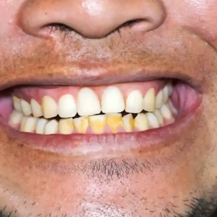 Plak kuning hilang gigi kembali putih cerah, coba trik pakai 1 bahan dapur