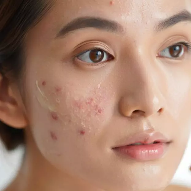 7 Langkah urutan makeup untuk kulit berjerawat agar tahan lama tanpa minyak