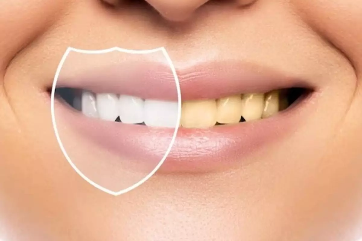 Gigi minim plak dan noda kuning tanpa repot pakai charcoal, wajib tahu trik ini