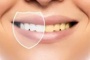 Gigi minim plak dan noda kuning tanpa repot pakai charcoal, wajib tahu trik ini