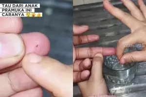 Trik keluarkan duri atau kayu kecil yang masuk ke kulit tanpa dicabut, cukup rendam 1 bahan dapur ini