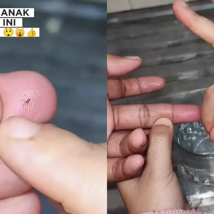 Trik keluarkan duri atau kayu kecil yang masuk ke kulit tanpa dicabut, cukup rendam 1 bahan dapur ini