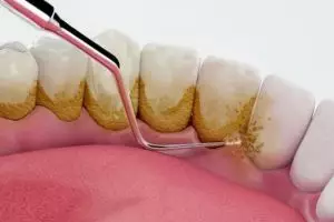 Luruhkan noda kuning dan plak gigi tanpa repot scaling, triknya pakai 2 bahan dapur