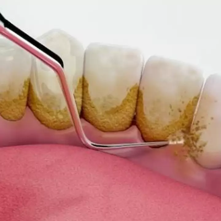 Luruhkan noda kuning dan plak gigi tanpa repot scaling, triknya pakai 2 bahan dapur