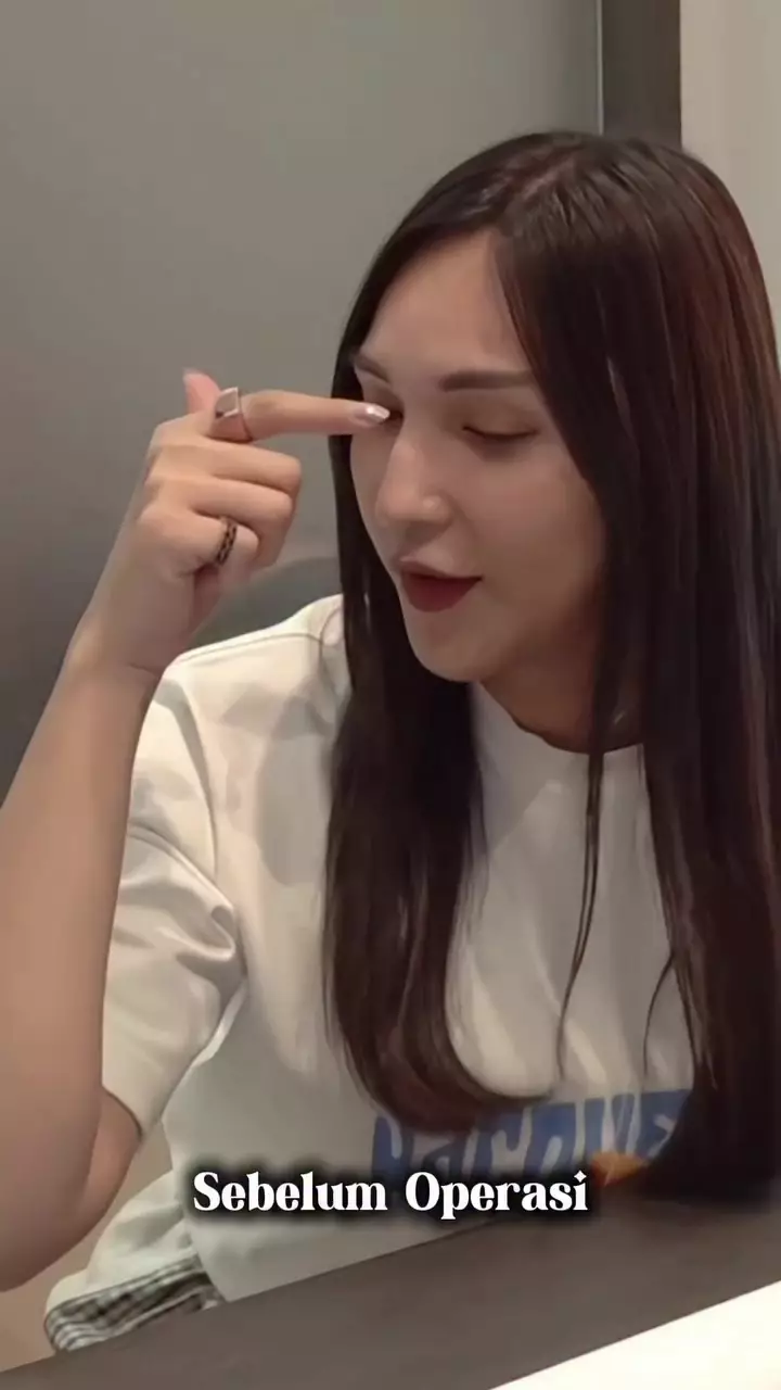 Foto Dena Rachman usai operasi plastik © 2025 Instagram Foto Dena Rachman usai operasi plastik © 2025 Instagram