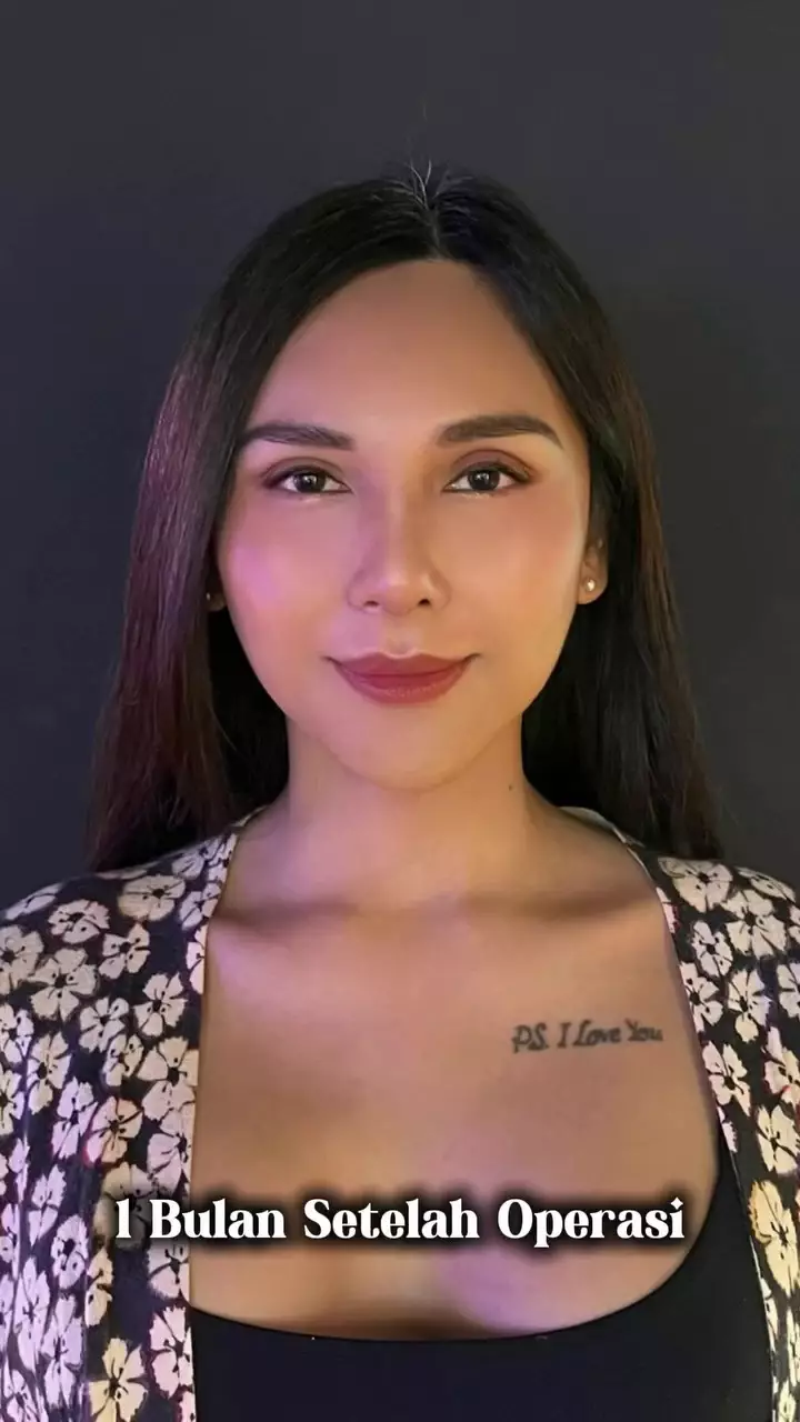 Foto Dena Rachman usai operasi plastik © 2025 Instagram Foto Dena Rachman usai operasi plastik © 2025 Instagram