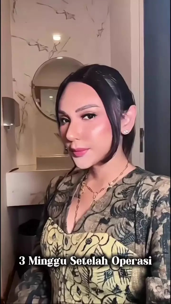 Foto Dena Rachman usai operasi plastik © 2025 Instagram Foto Dena Rachman usai operasi plastik © 2025 Instagram