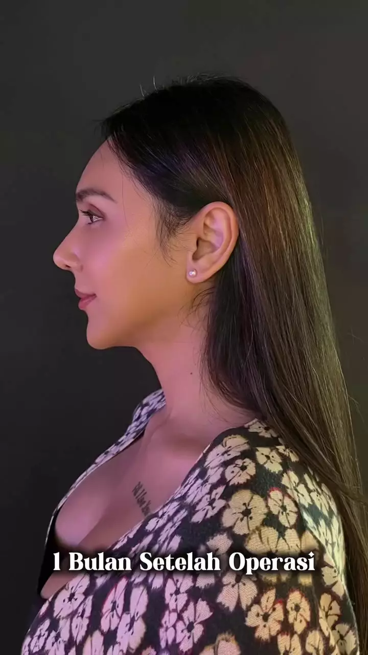 Foto Dena Rachman usai operasi plastik © 2025 Instagram Foto Dena Rachman usai operasi plastik © 2025 Instagram