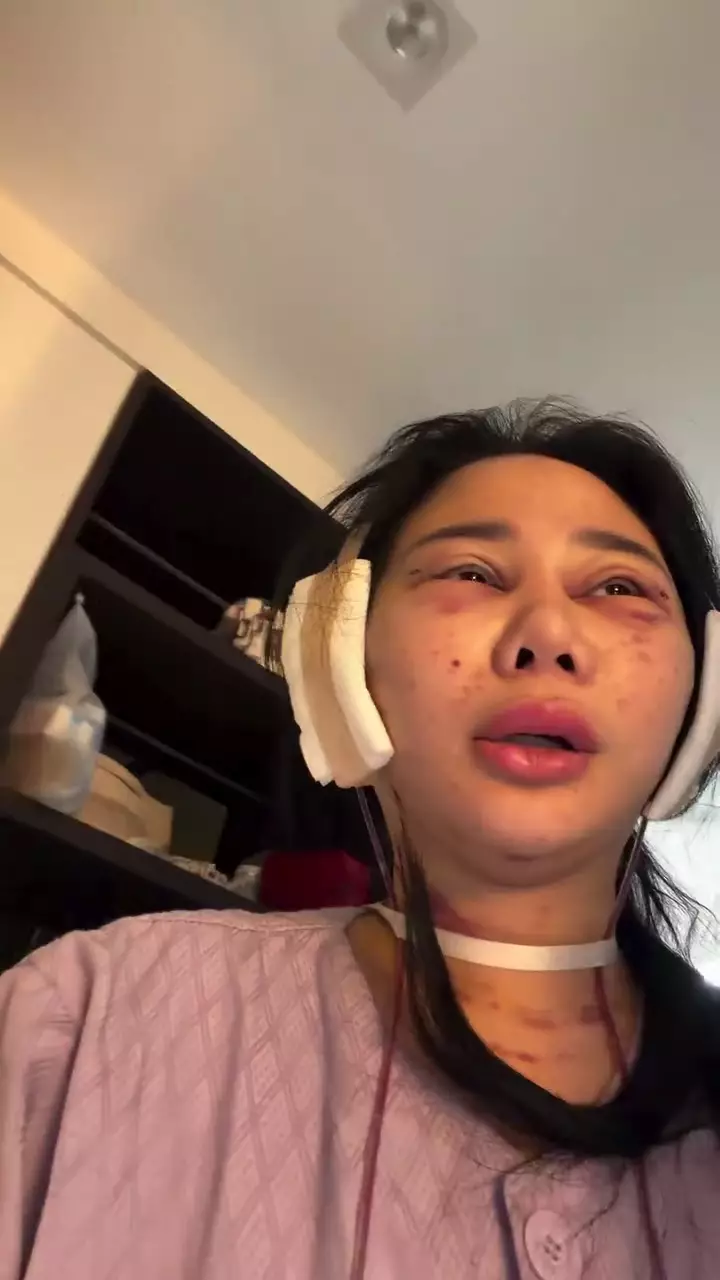 Denise Chariesta oplas wajah di Korea Selatan © 2025 Instagram Denise Chariesta oplas wajah di Korea Selatan © 2025 Instagram